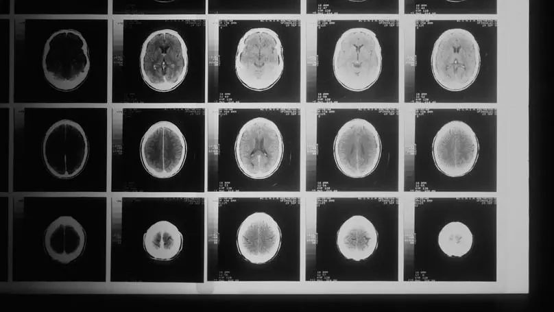 Development of a Multimodal Machine Learning-Based Prognostication Model for Traumatic Brain Injury : A CENTER-TBI and CINTER-TBI Study